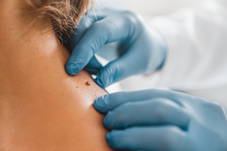 Diagnostyka i leczenie nowotworów skóry – dlaczego regularna kontrola u dermatologa jest ważna?